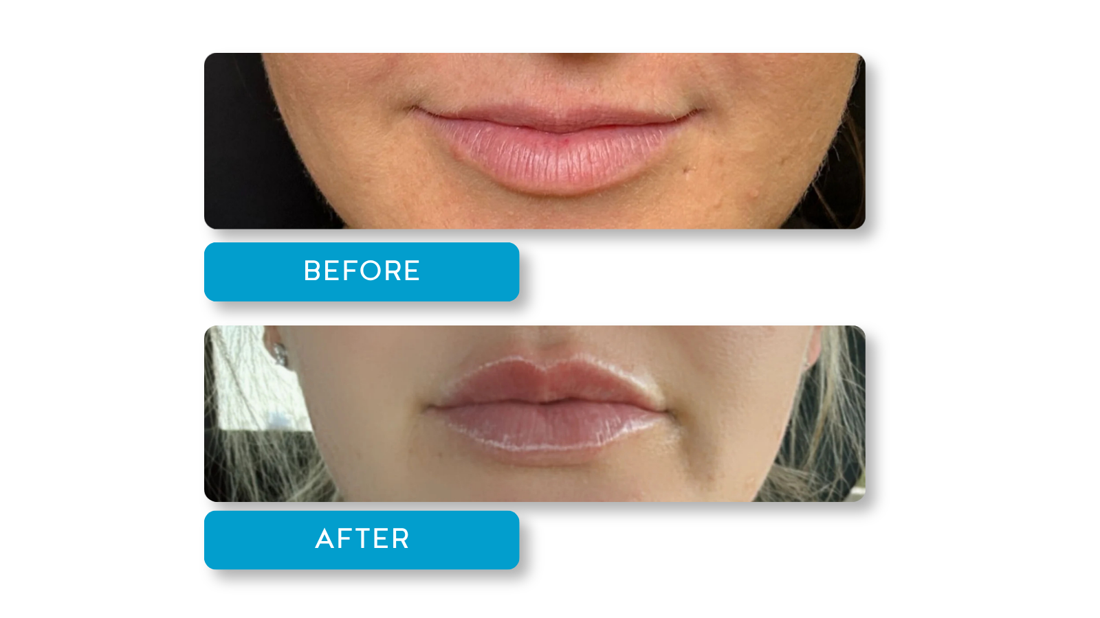 Real patient, Lip filler results on female model from A Younger You Aesthetics Med Spa
