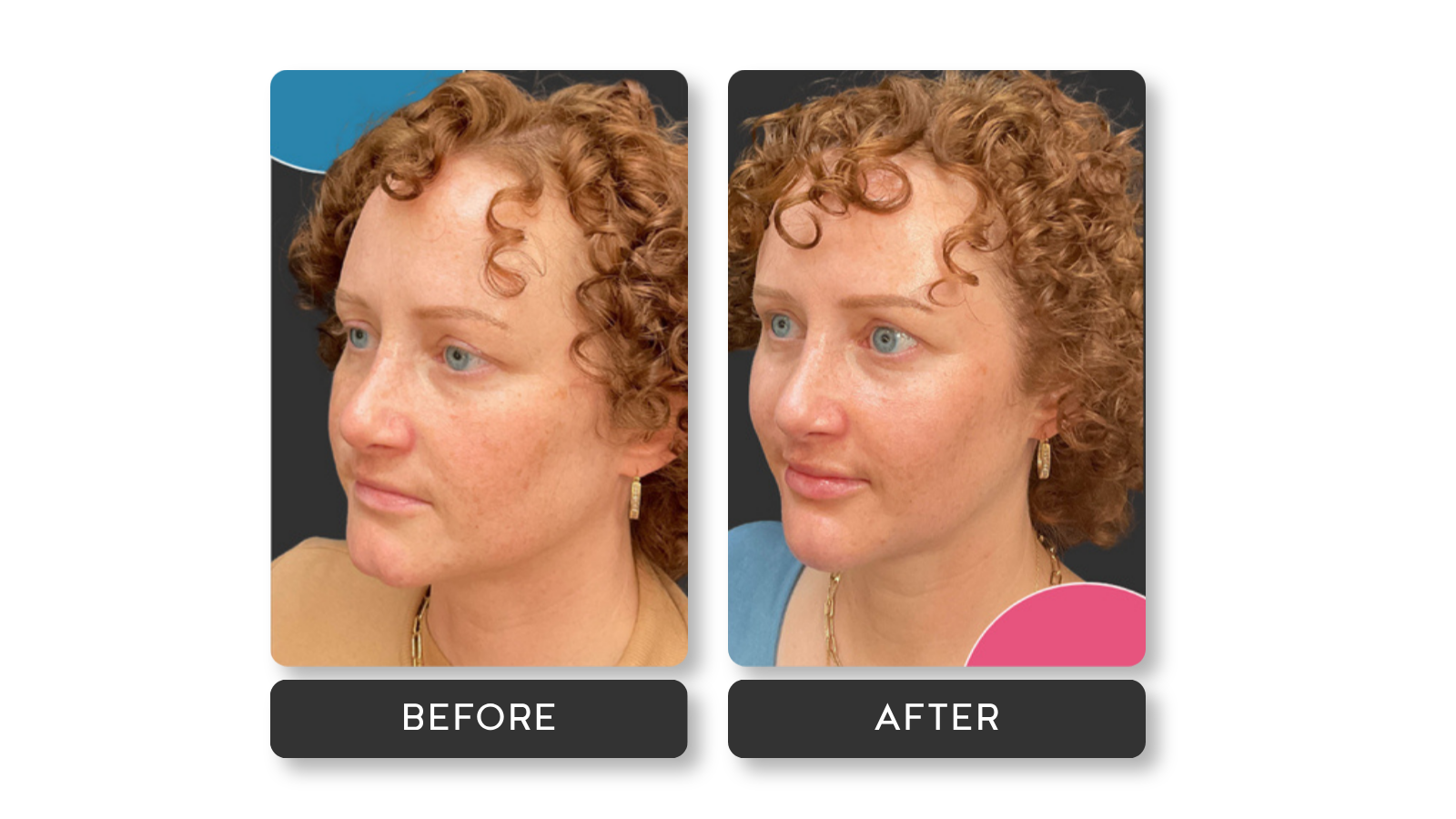 Mini refresh results on female model from A Younger You Aesthetics Med Spa