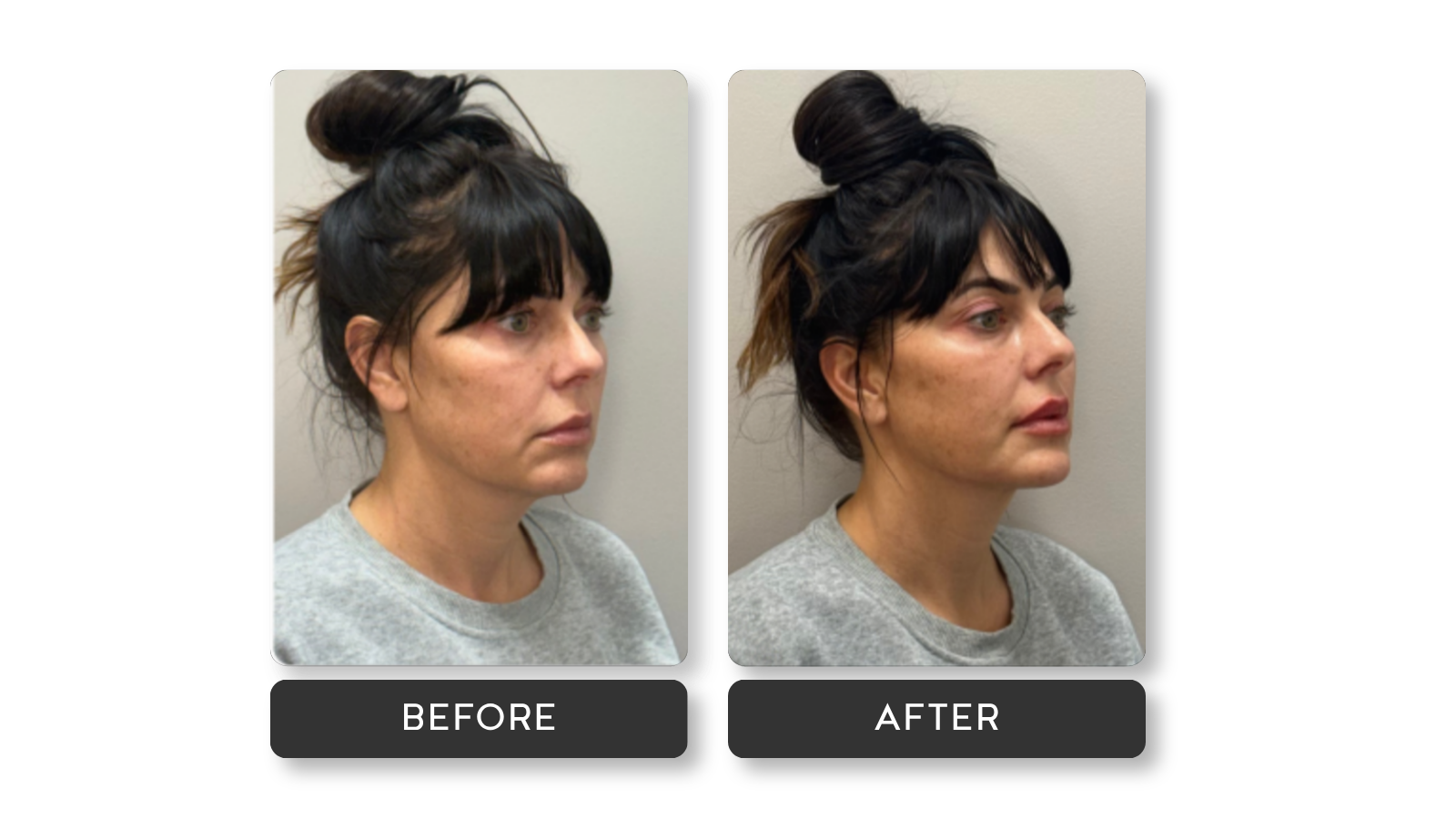 Signature lip results from A Younger You Aesthetics MedSpa