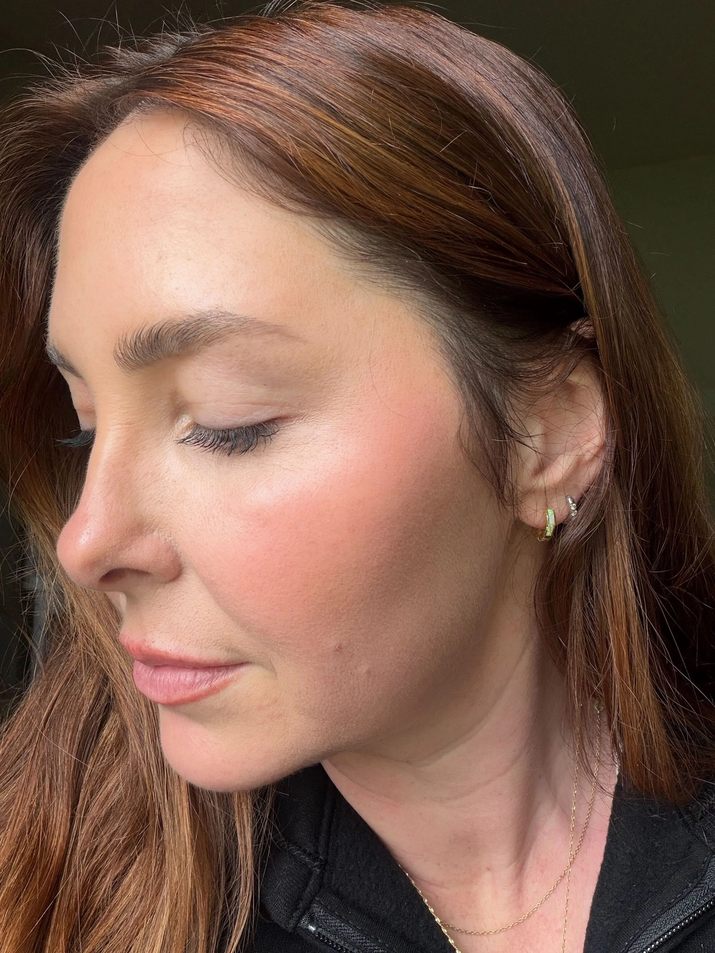 Real patient results, The Signature Glow protocol.  Patient has hydrating, smooth and glowing skin