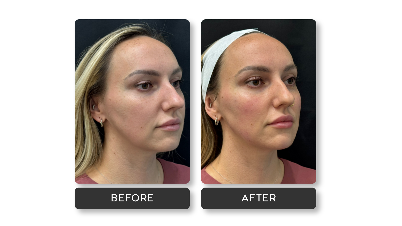 Side-by-side comparison of a woman's face before and after a skincare or cosmetic treatment, with visible improvements in skin texture and redness correction. In the after photo, she wears a white headband and has smoother, more even skin.