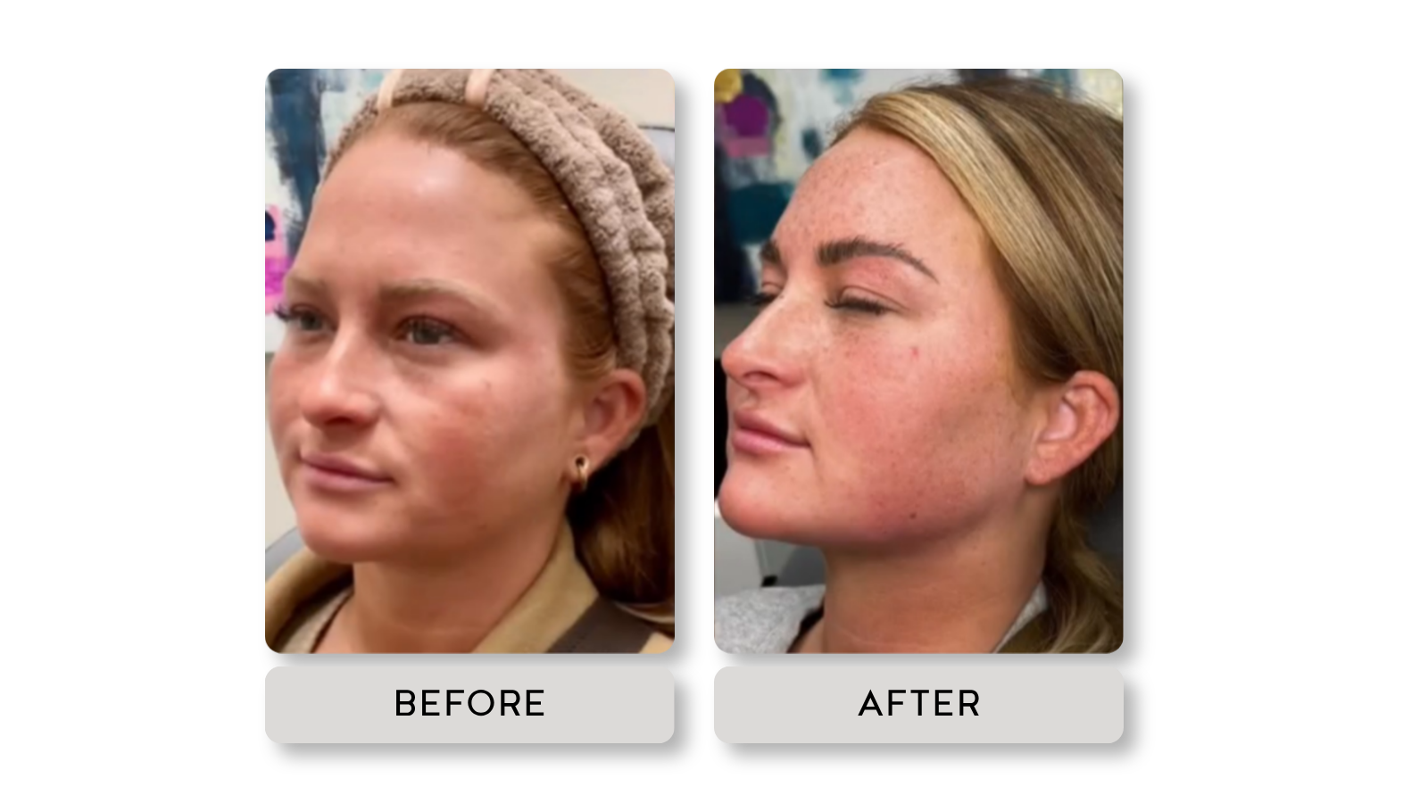 Side-by-side comparison of a woman before and after a skincare treatment, showing clearer skin and reduced redness in the after image.