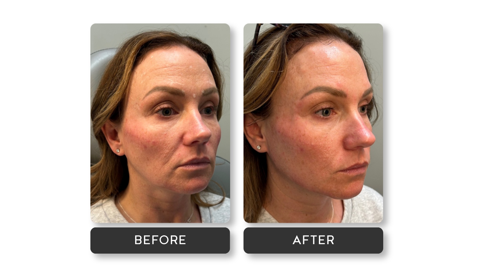 Liquid Facelift results on model from A Younger You Aesthetics Med Spa