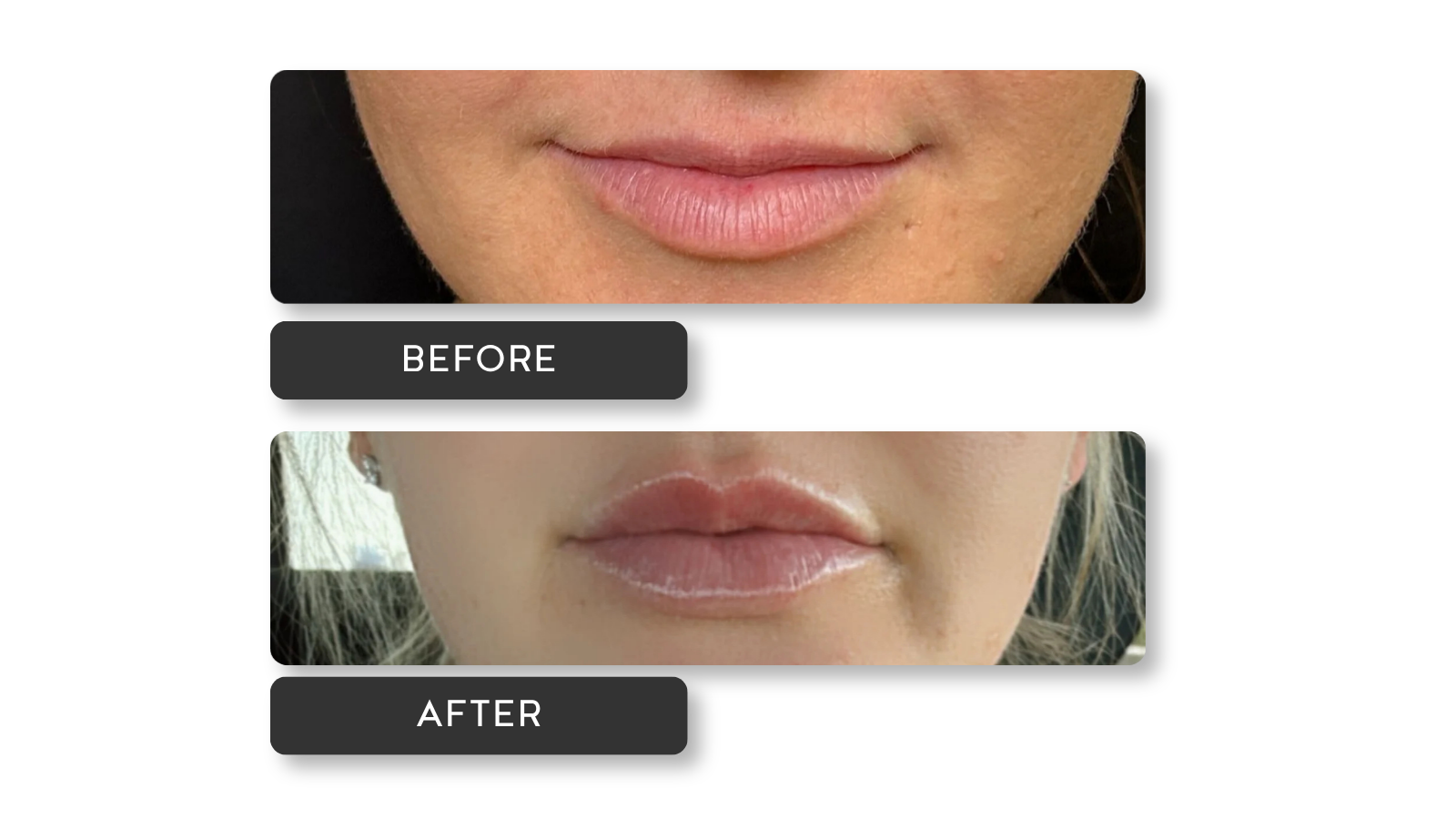 Signature lip results from A Younger You Aesthetics MedSpa