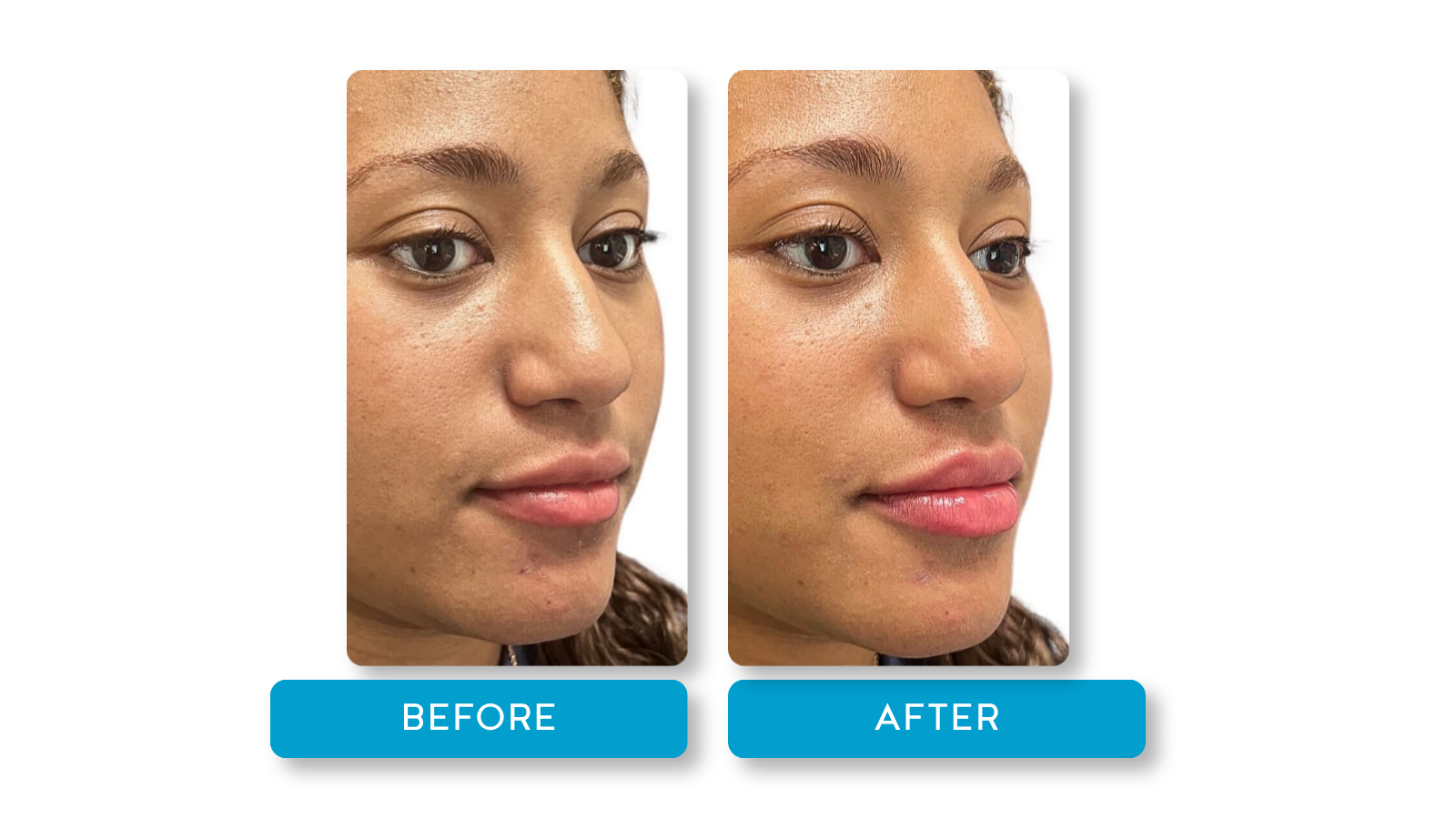 Real patient, Lip filler results on model from A Younger You Aesthetics Med Spa