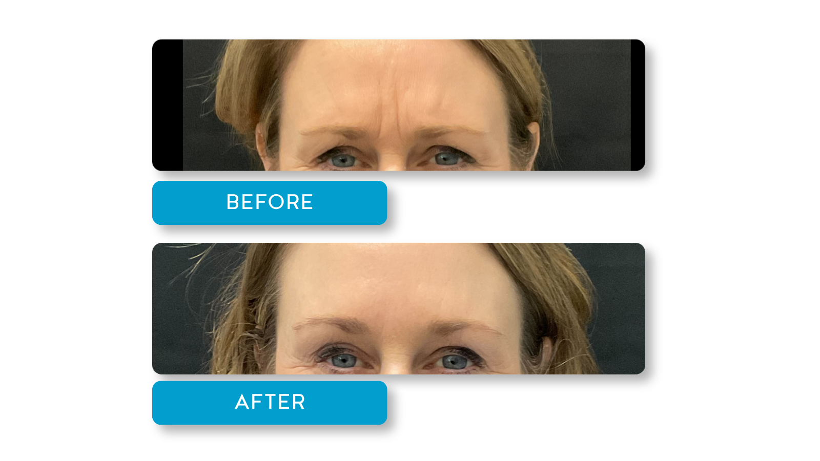 Real Botox results from A Younger You Aesthetics