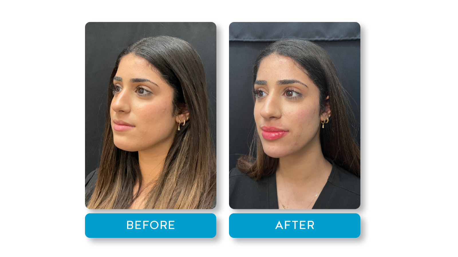 Real patient, Lip filler results on model from A Younger You Aesthetics Med Spa