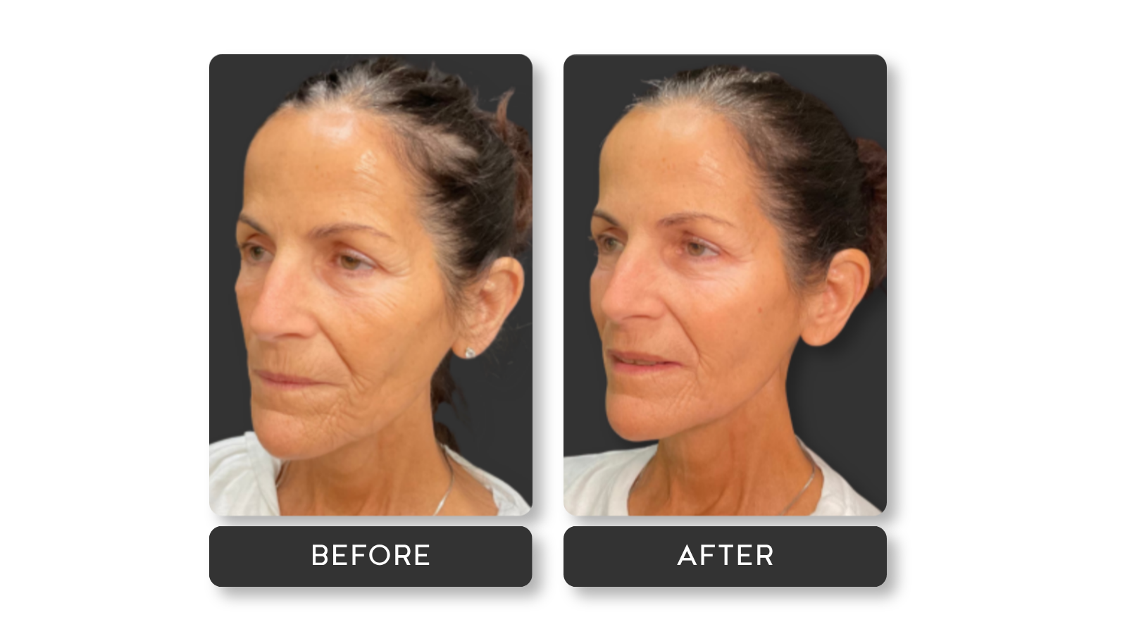 Signature Refresh Before and After Results from A Younger You Aesthetics
