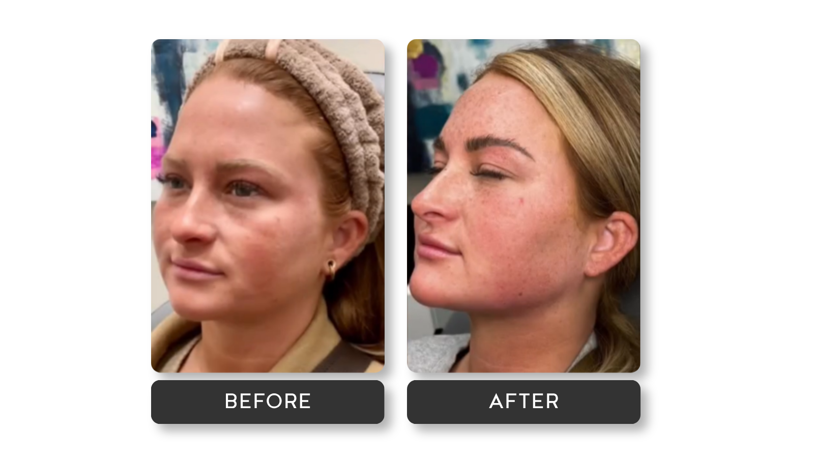 Signature Refresh results on model from A Younger You Aesthetics Med Spa