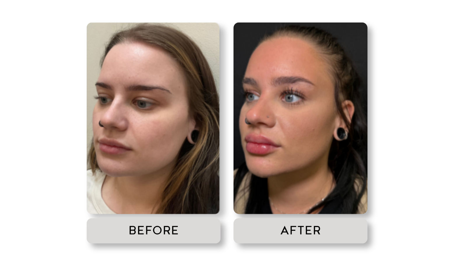 Side-by-side comparison of a woman labeled 'Before' and 'After' showing changes in her facial appearance, including fuller lips and enhanced makeup in the 'After' image.