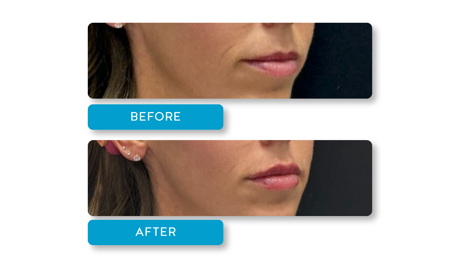 Real patient, Lip filler results on model from A Younger You Aesthetics Med Spa