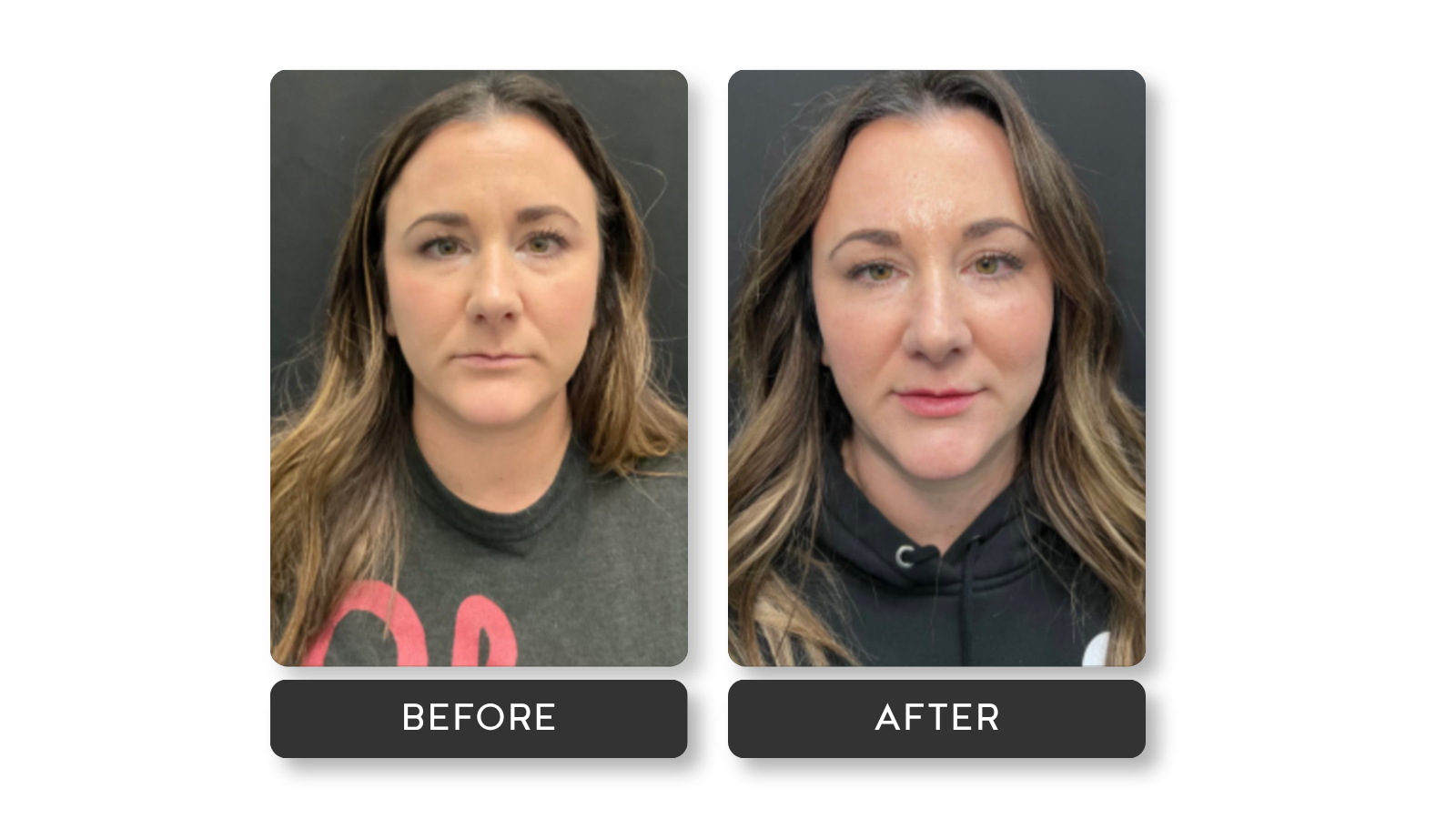 Signature lip results from A Younger You Aesthetics MedSpa