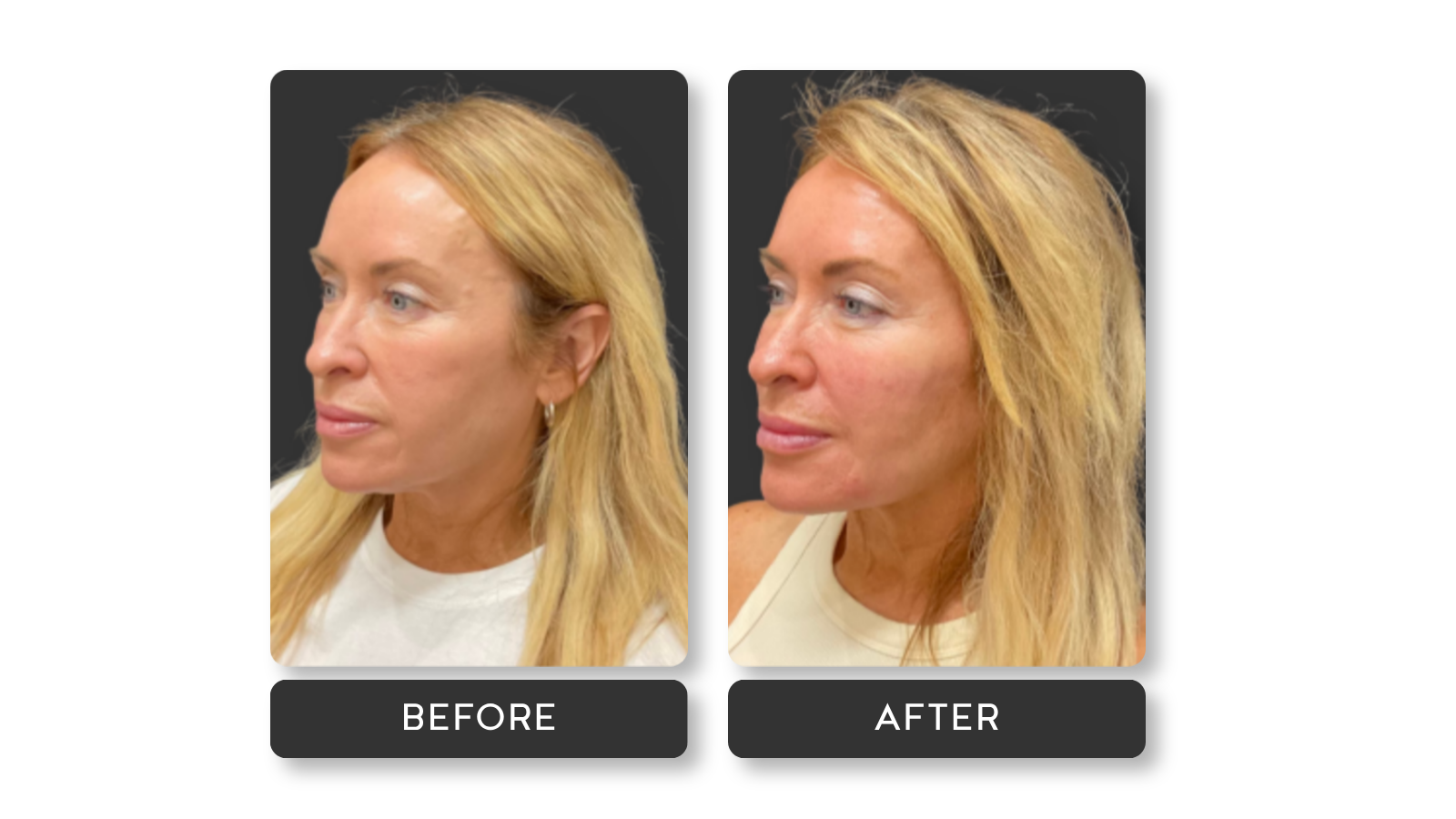 Actual results of Mini Refresh package from A Younger You Aesthetics