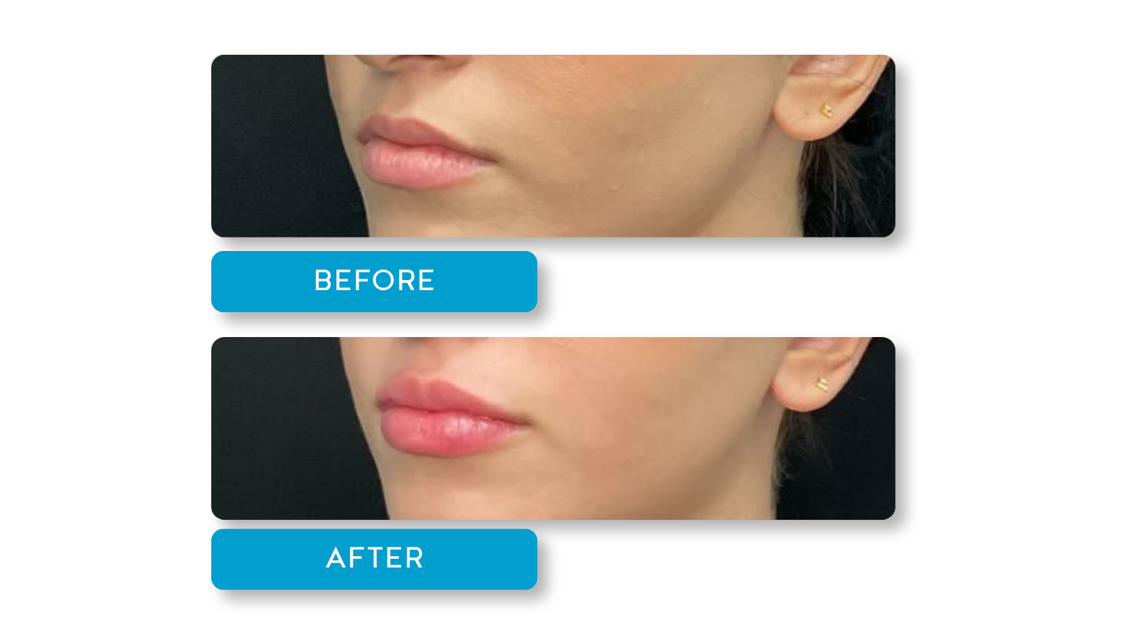 Real patient, Lip filler before and after results on model from A Younger You Aesthetics Med Spa