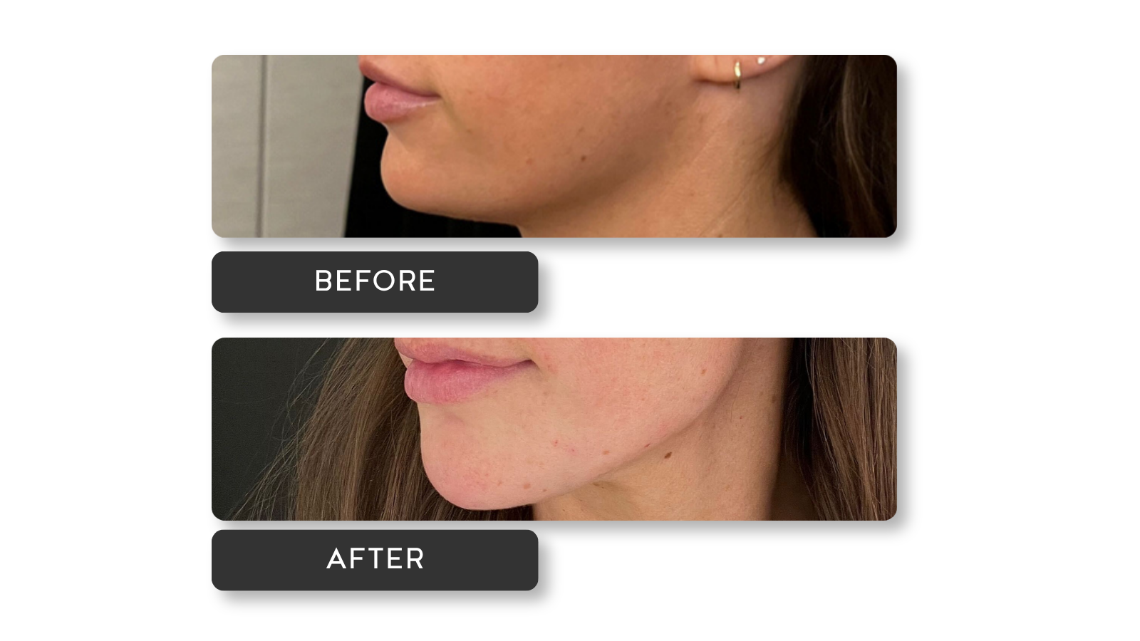 AYYA_Before and After_Signature Jawline