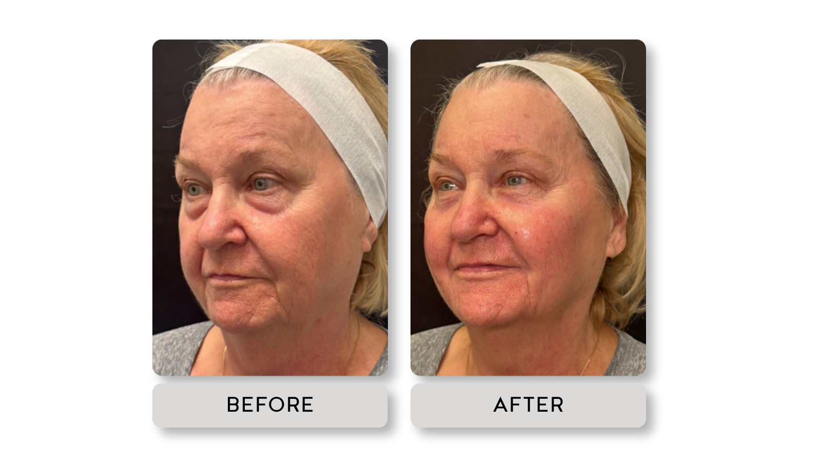 Side-by-side comparison of a woman before and after skin treatment showing improved skin texture and redness reduction.