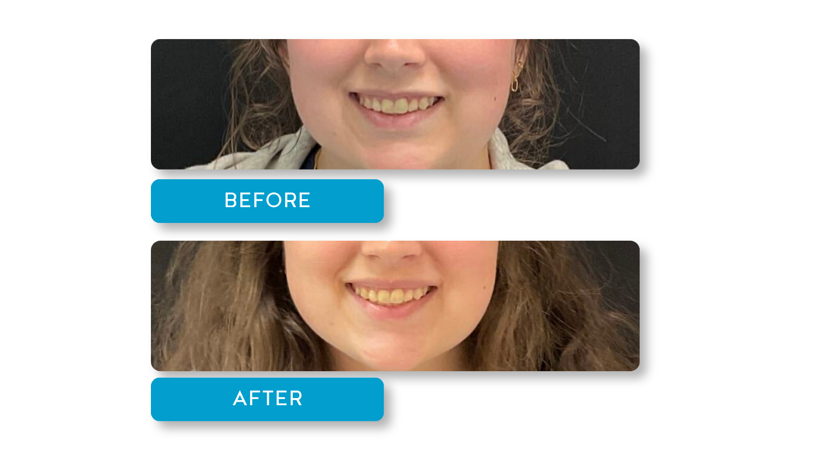 Comparison of a woman's smile before and after dental treatment, showing improved teeth alignment and brightness in the after photo.