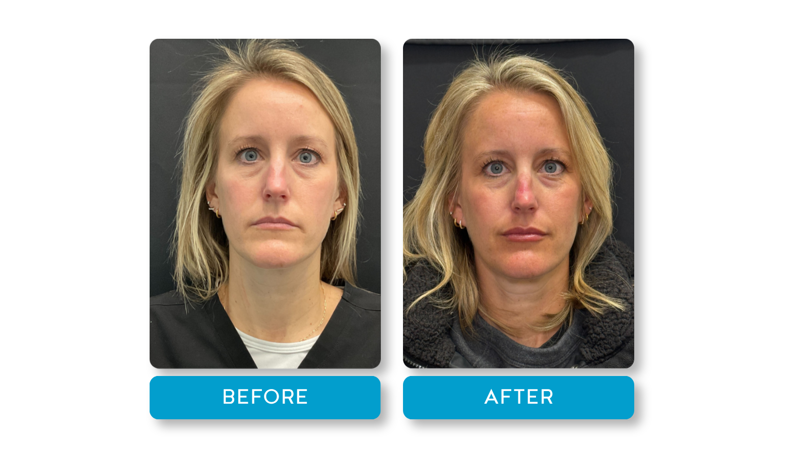 Real lip filler results from Providers at A Younger You Aesthetics
