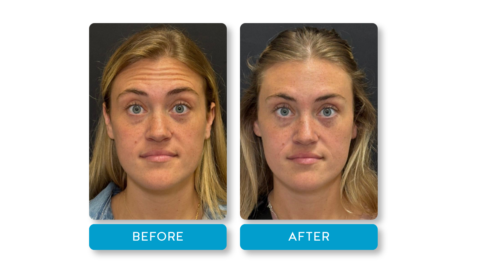 Real botox results from A Younger You