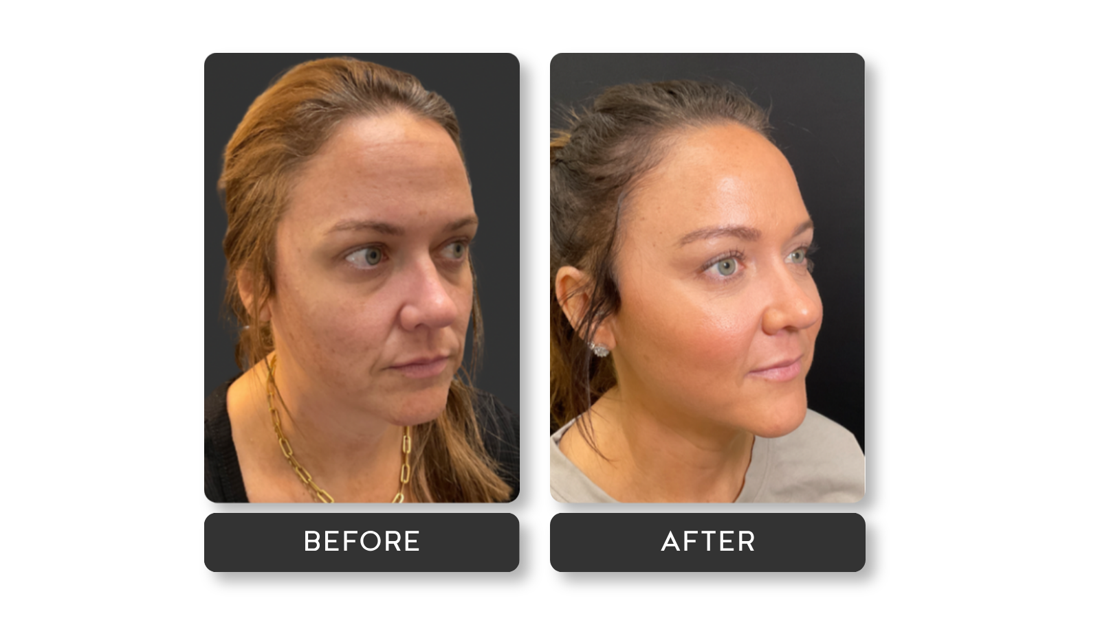 Liquid Facelift results on model from A Younger You Aesthetics Med Spa
