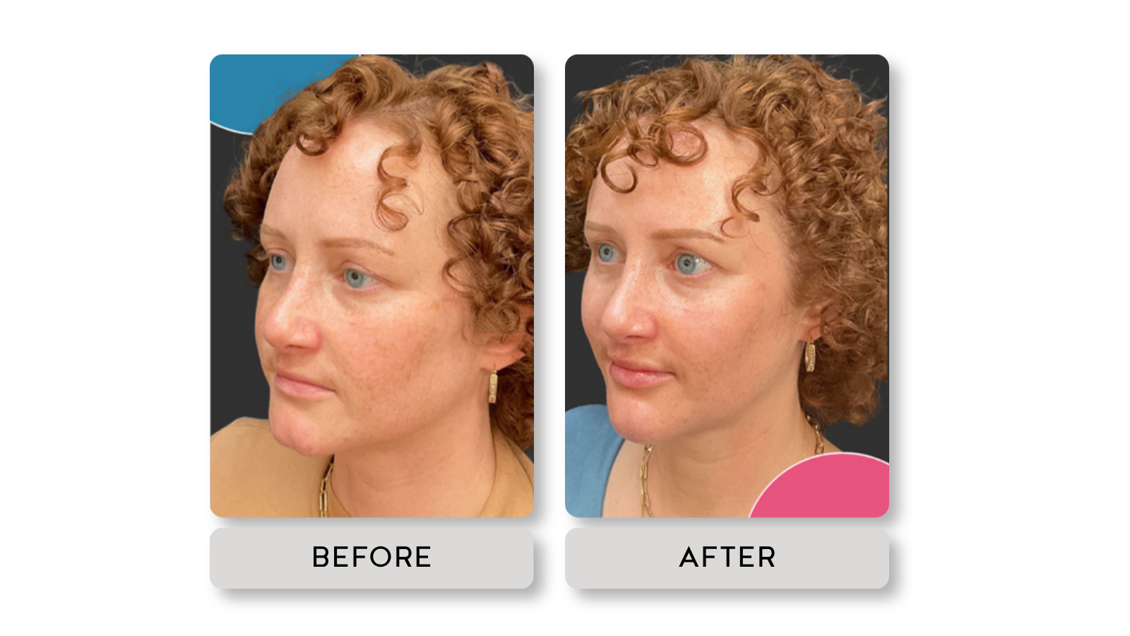 Side-by-side comparison of a woman before and after skin treatment, showing clearer skin and reduced pigmentation in the after photo.