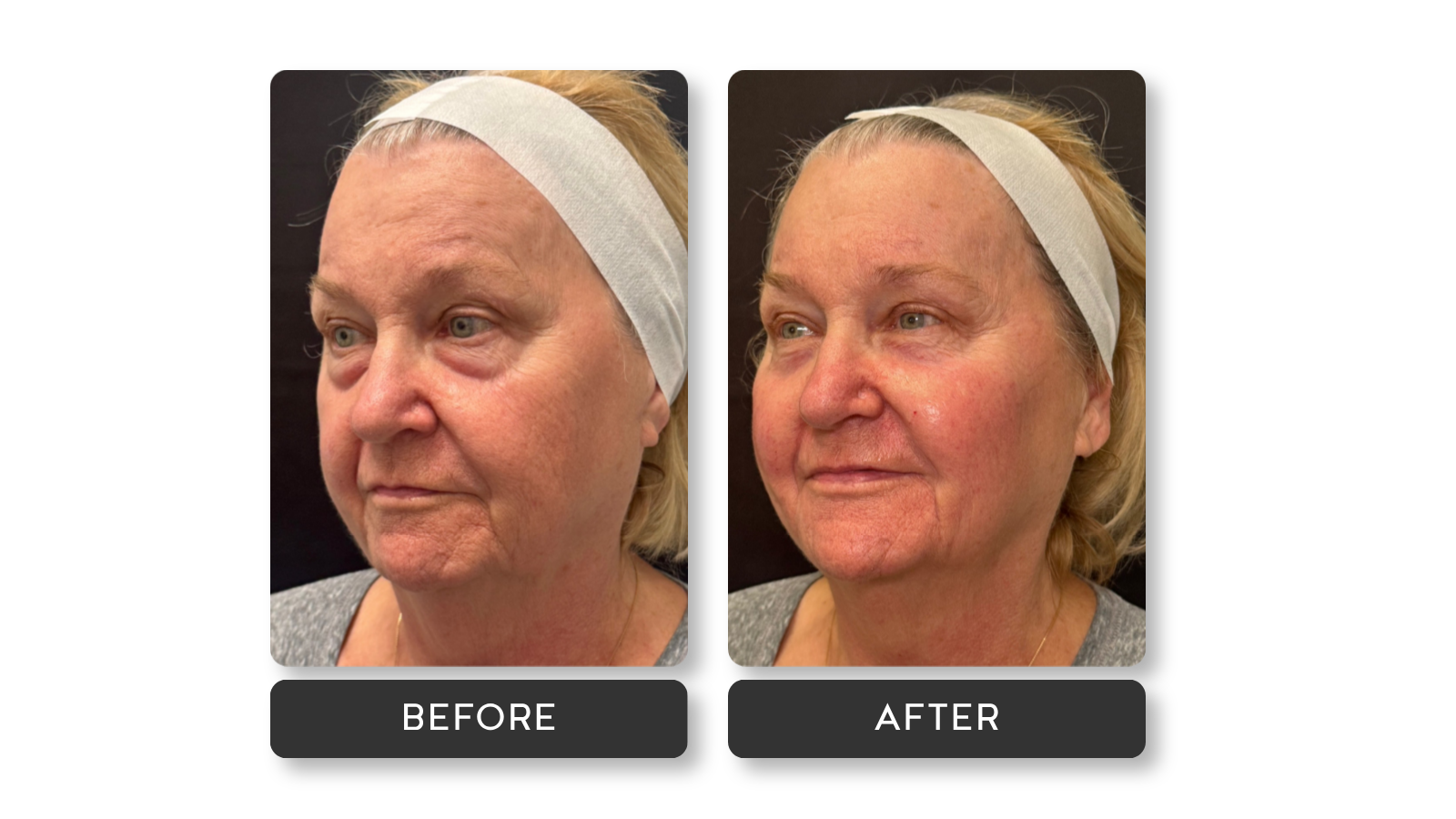 Liquid Facelift results on model from A Younger You Aesthetics Med Spa
