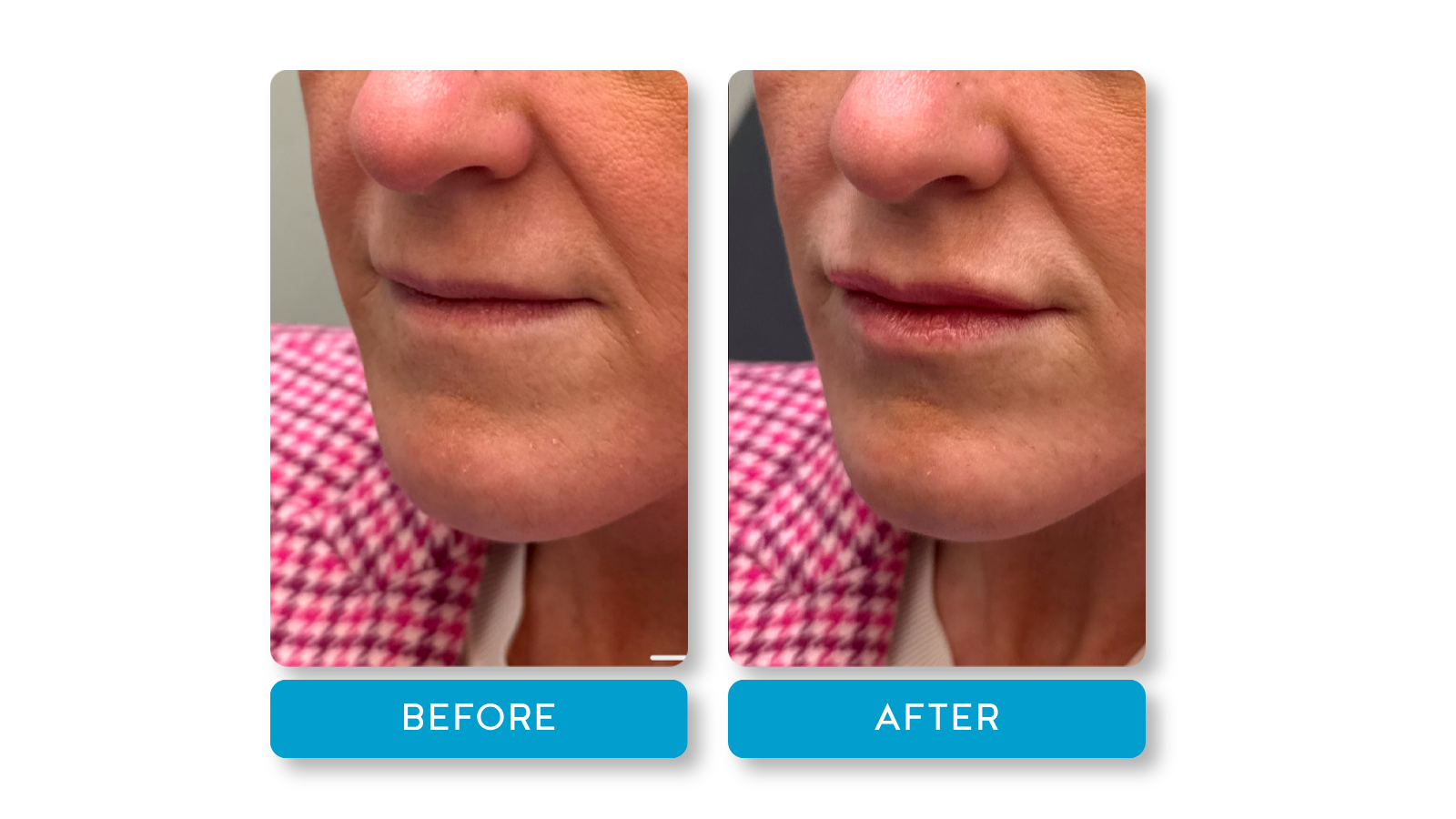 Real patient, Lip filler results on male model from A Younger You Aesthetics Med Spa