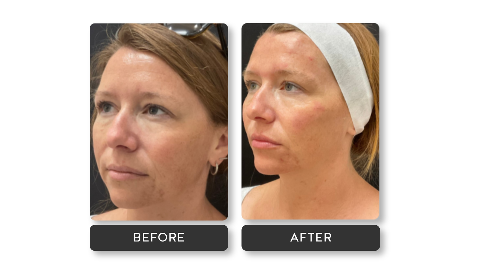 before and after results on female model from A Younger You Aesthetics Med Spa