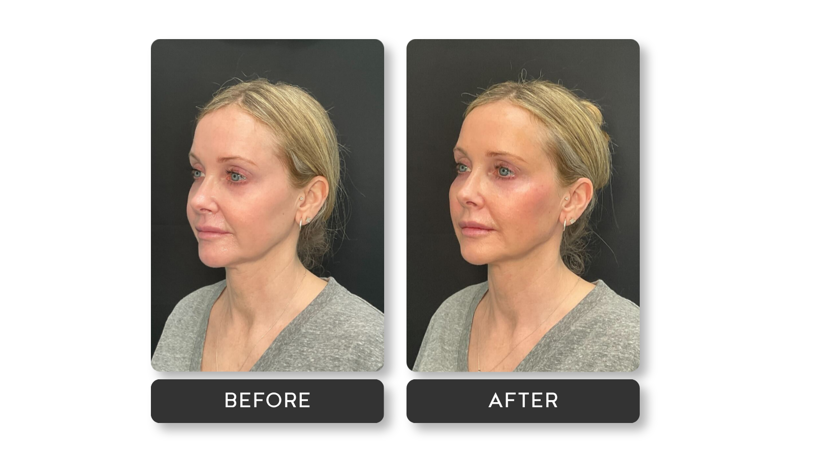 Signature Jawline results on female model from A Younger You Aesthetics Med Spa