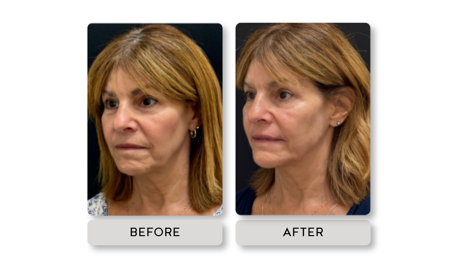 Side-by-side comparison of a woman before and after cosmetic treatment, showing improvements in facial appearance and skin texture.