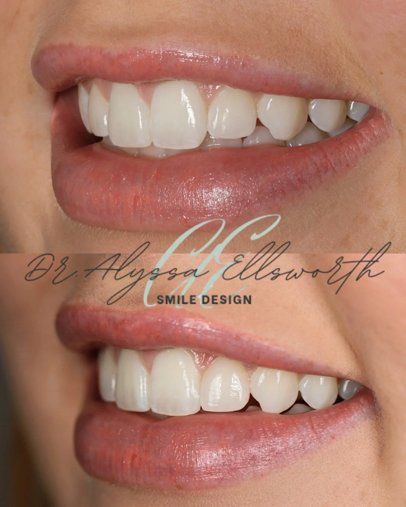 We love a subtle smile enhancement with no numbing and no drilling! Our patient had stubborn lateral incisors (next to the two front teeth) that wouldn’t move with Invisalign, and were small proportionately to her other teeth. We used two NO PR