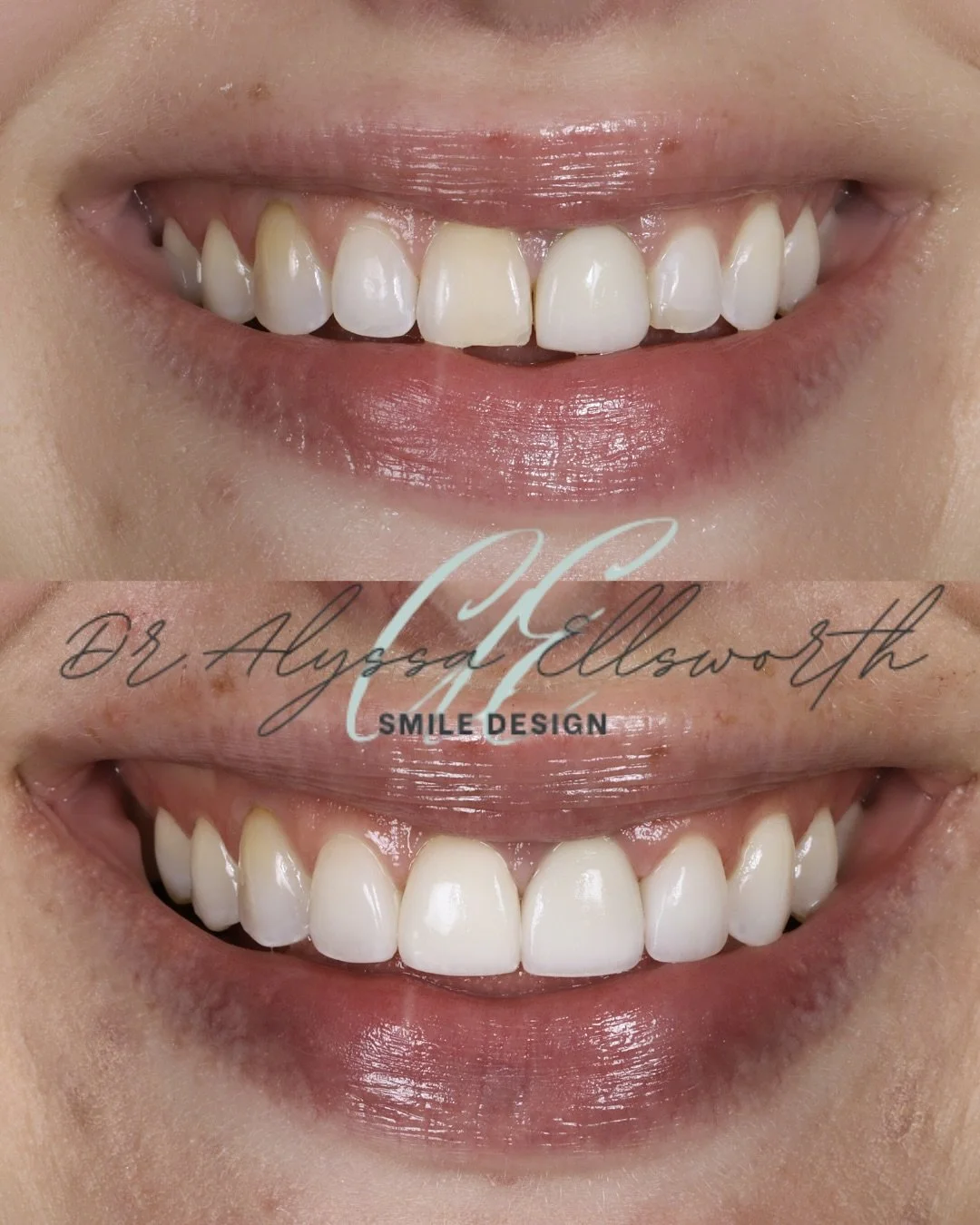 Ready for a SMILE REFRESH like this one?? 
Click on the link in our bio 🔗 to submit for your complimentary and virtual cosmetic consultation to get started! 
#denverinvisalign #invisalign #invisalignprovider #denverveneers #cosmeticdentistdenver #c