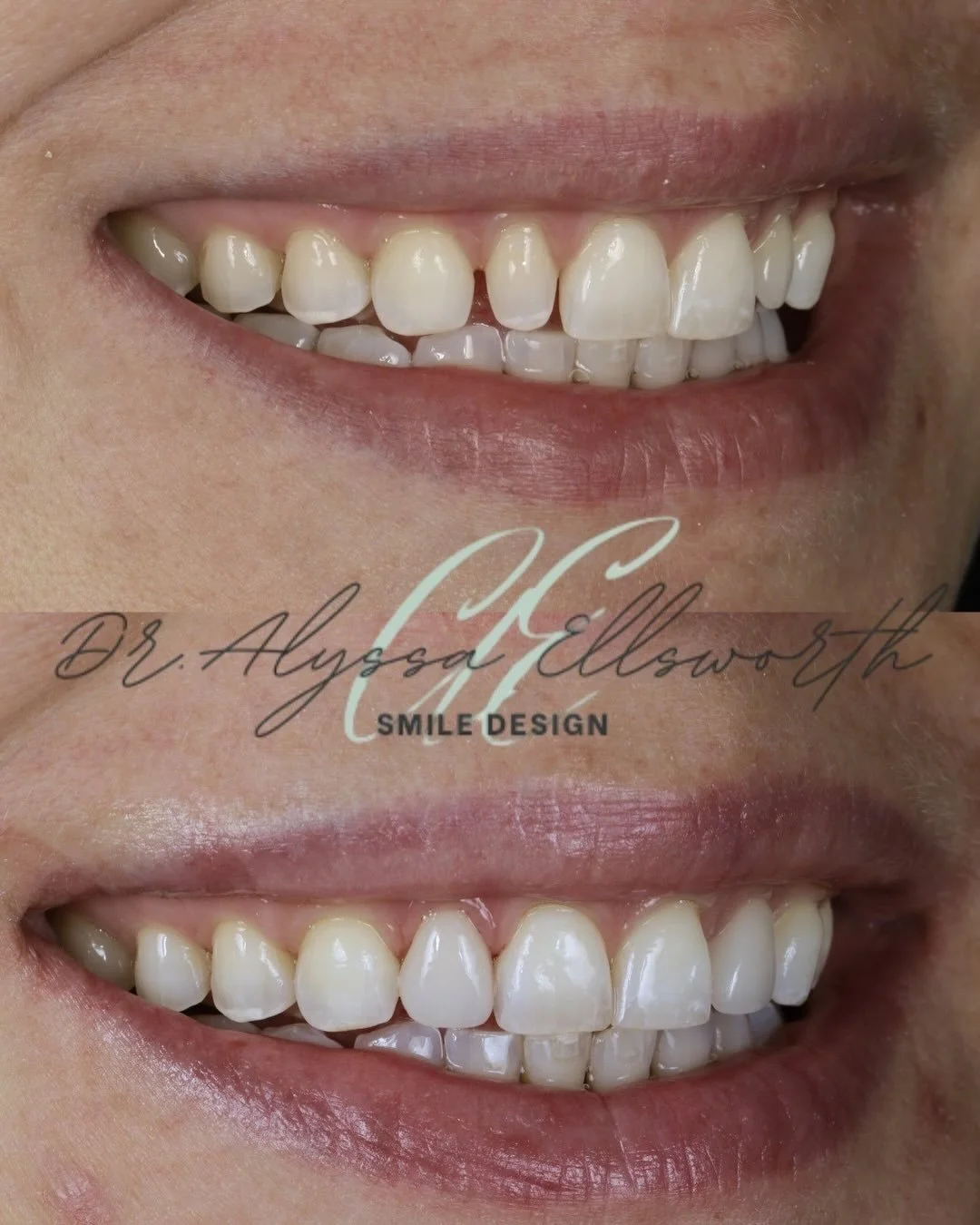 A subtle change that makes a stunning difference. 🦷

This smile had a beautiful, natural shape to begin with. With precise cosmetic enhancements, refined symmetry, and gentle shade correction, we elevated what was already there while keeping everyth