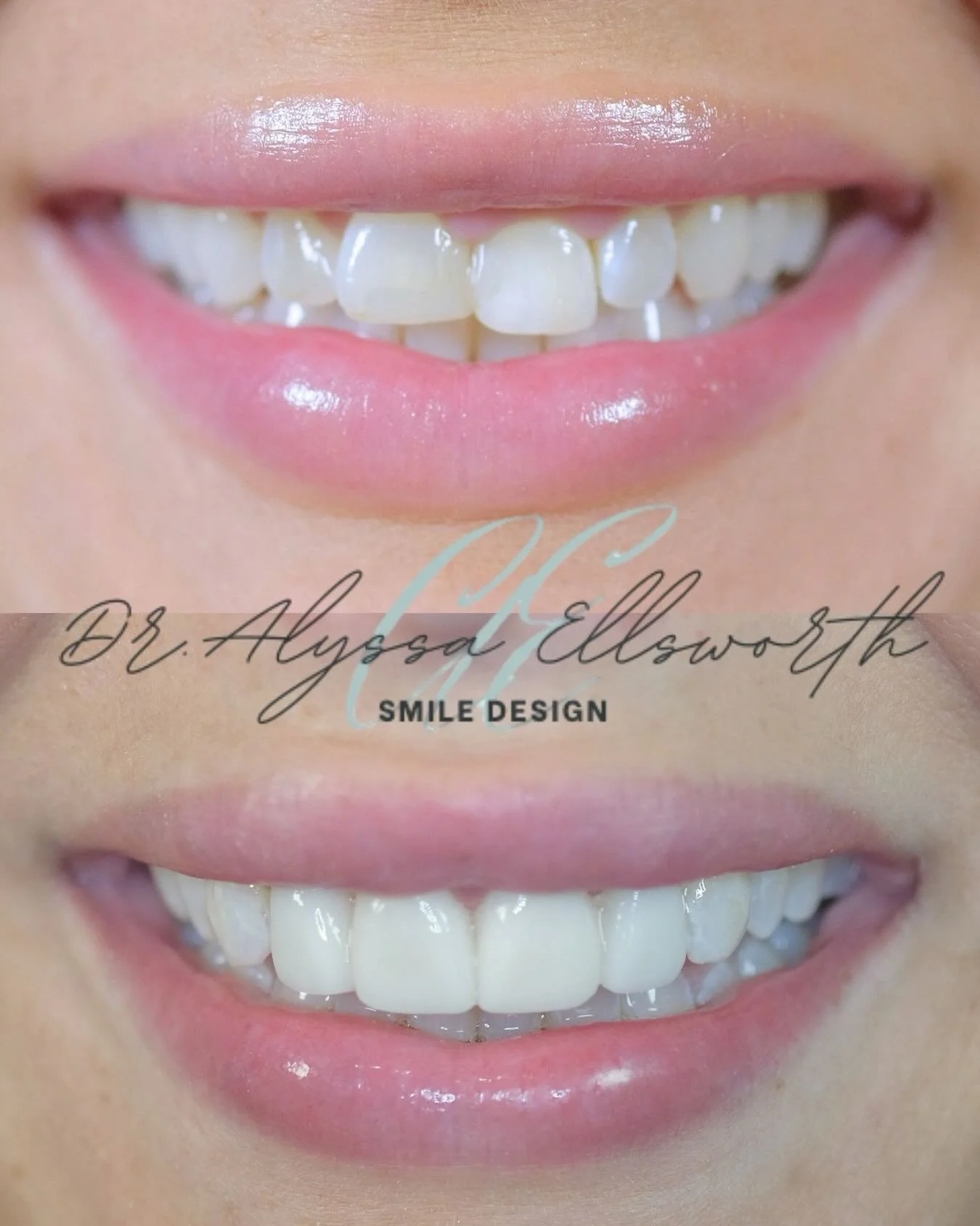 A confident smile starts long before the final porcelain is placed. 🦷
At Queen City Smiles, we design every veneer case with intention, artistry, and a clear preview of your results.

This case includes four veneers; the bottom photo shows our tempo