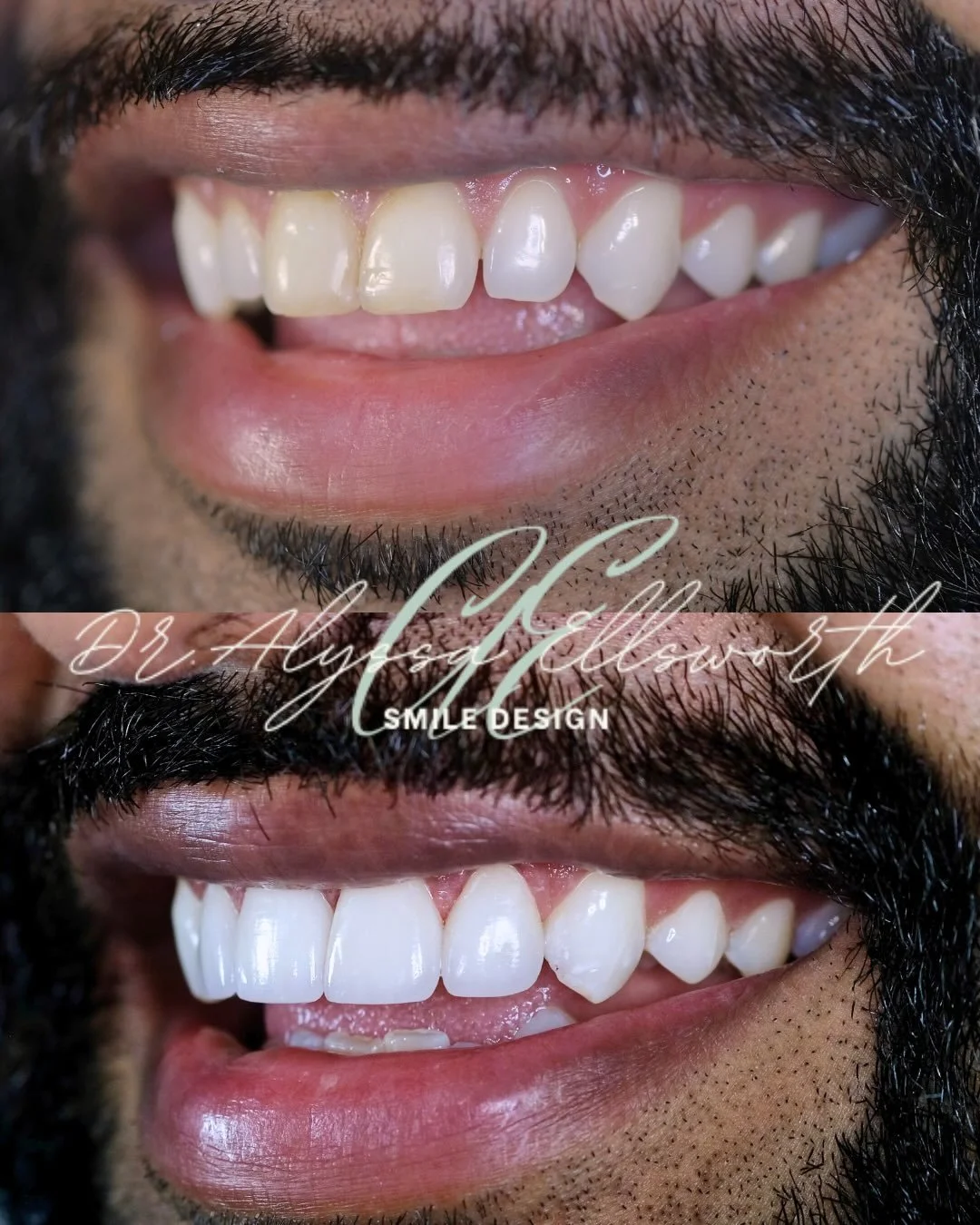 Designed to feel your best. 🖤
These veneers were crafted to enhance brightness, refine shape, and create a smile that looks polished, confident, and natural.

Every detail is intentionally planned, so the final result feels seamless rather than over