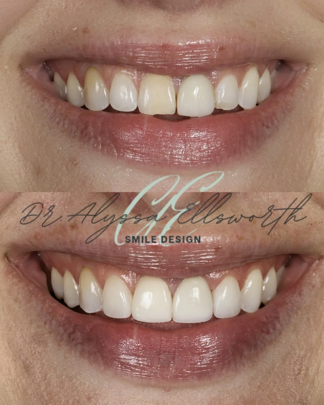 A brighter and straighter smile can still look completely natural.
These veneers were thoughtfully designed to enhance shape, tone, and symmetry while honoring the patient&rsquo;s original features.

Subtle changes, precise planning, and custom craft