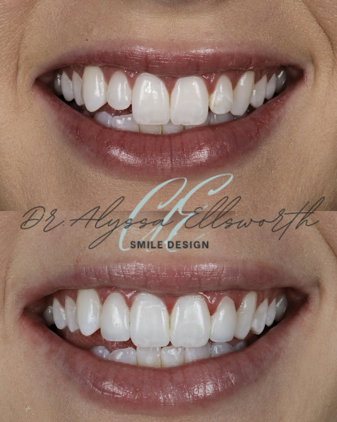 When proportions are refined, the entire smile can shift.

This case highlights no-prep veneers on the two lateral incisors, designed to create greater symmetry and visual balance.

By addressing just these two teeth, we achieved a brighter, more coh