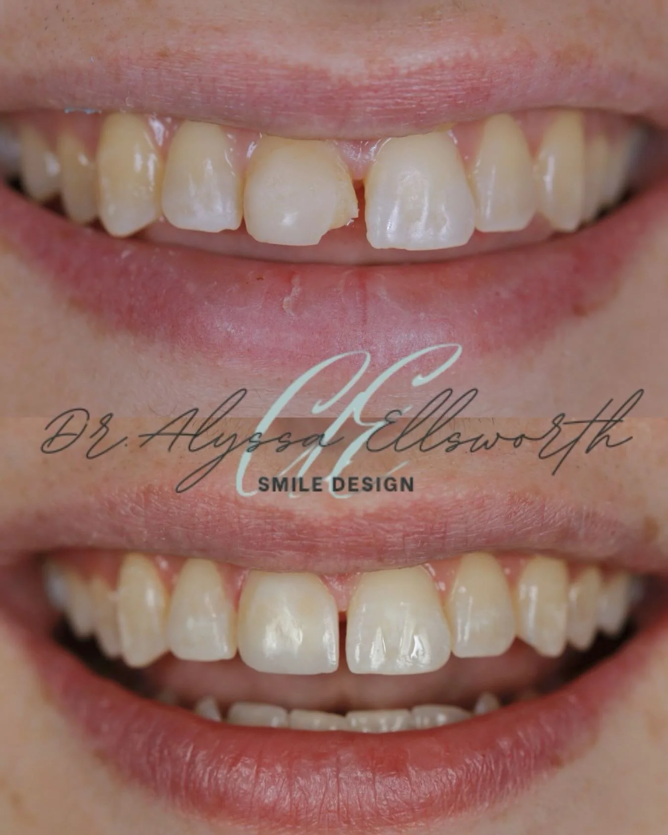 A chipped tooth can happen in a second. Fixing it should be seamless.

This before-and-after shows how a small fracture to a front tooth was carefully restored to match the natural shape, shade, and symmetry of the surrounding smile.

No bulky bondin