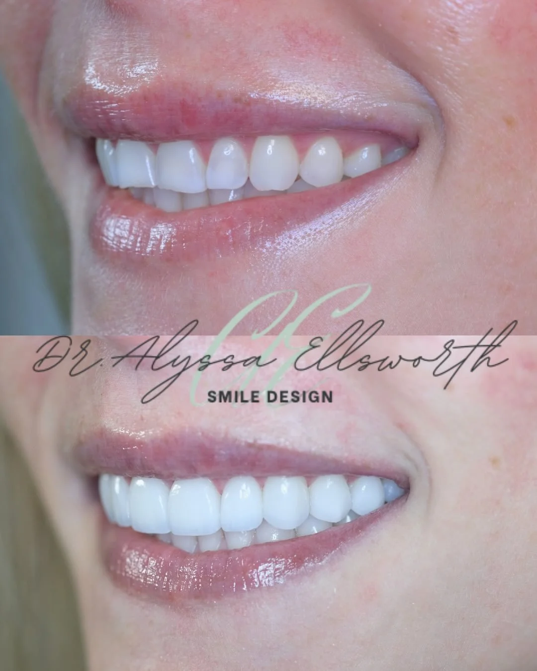 No prep veneers provide a conservative approach to smile design by enhancing shape, symmetry, and tone while preserving natural tooth structure.
Each case is carefully planned to ensure proper function, proportion, and long-term integrity so the fina