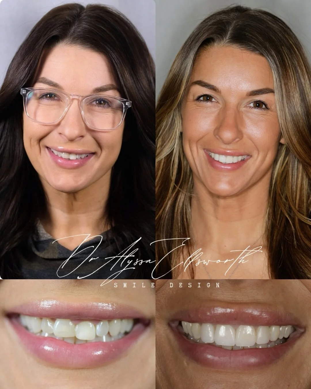 Small, precise changes can have a meaningful impact on a smile.
In this case, four custom porcelain veneers were used to improve the proportions, symmetry, and overall brightness of the upper front teeth while maintaining a natural appearance.

Smile