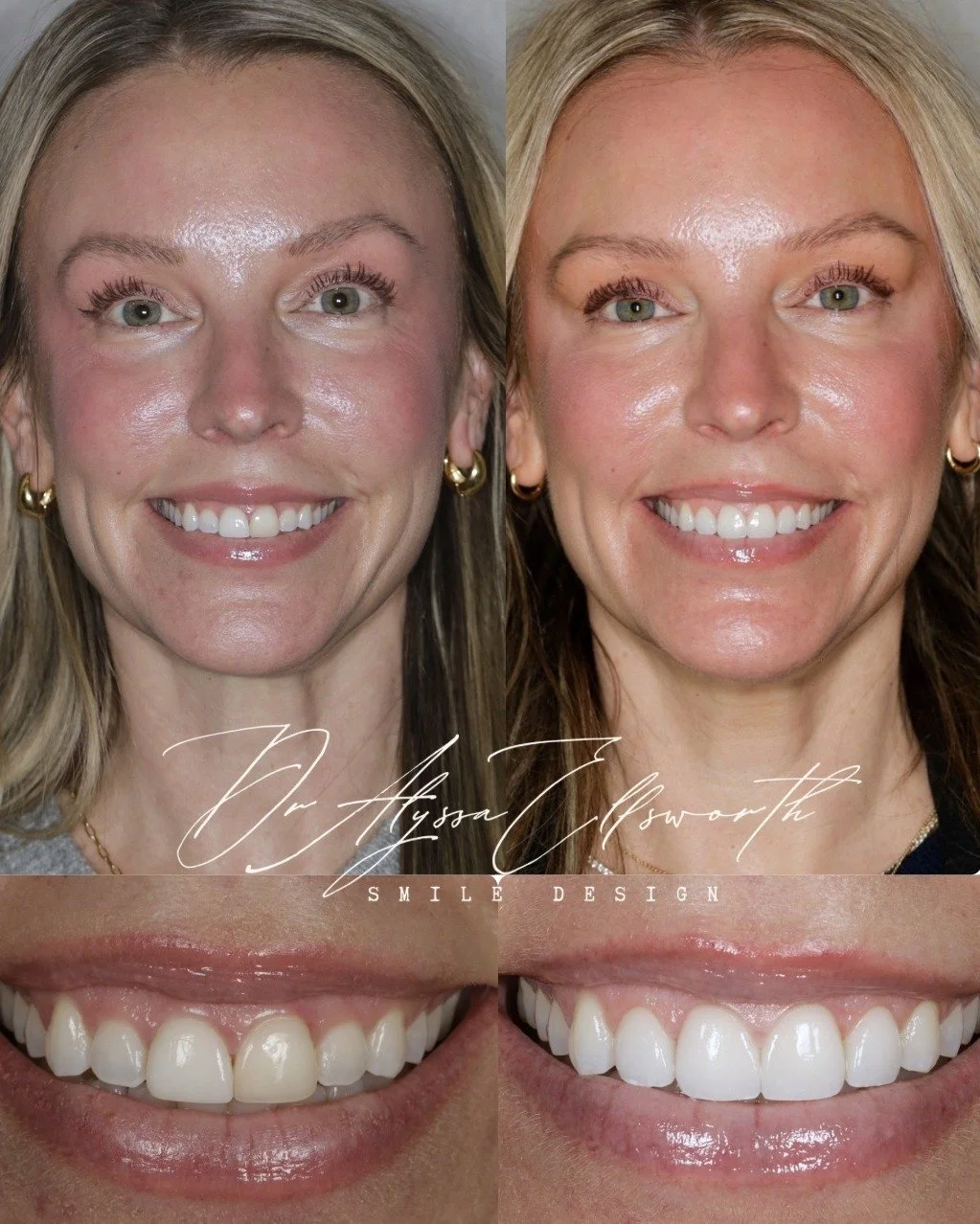 For this case, treatment focused on refining tooth proportions, contour, and value while preserving the patient&rsquo;s natural characteristics. 

The objective was not to overcorrect, but to improve balance, light reflection, and overall integration