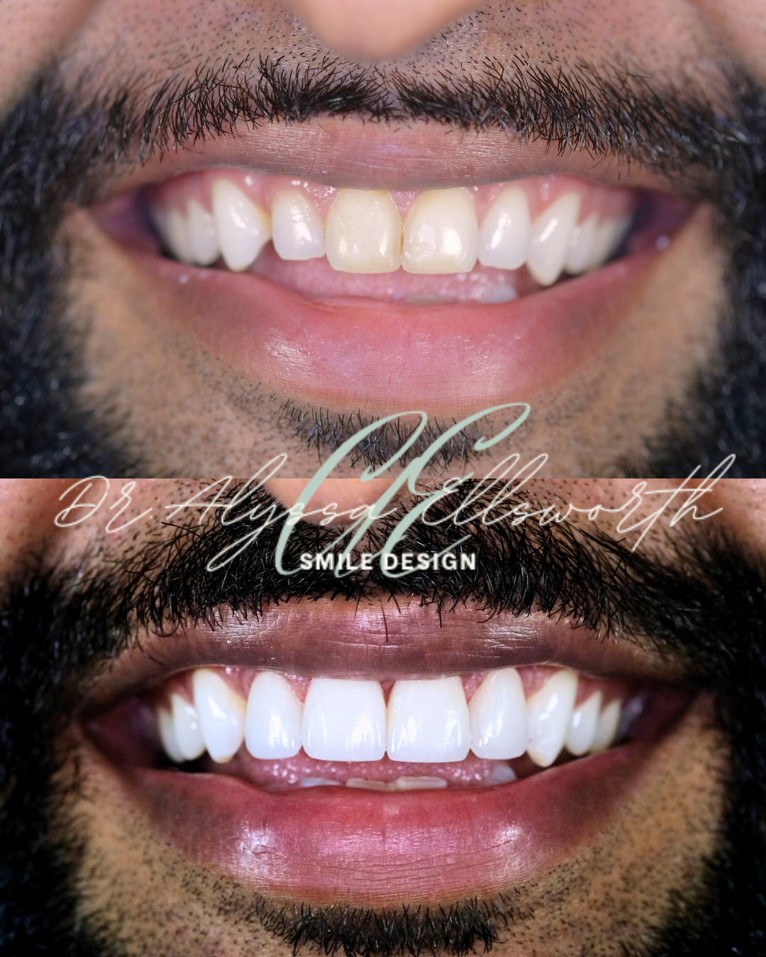 Invisalign, Veneers, Botox — Queen City Smiles