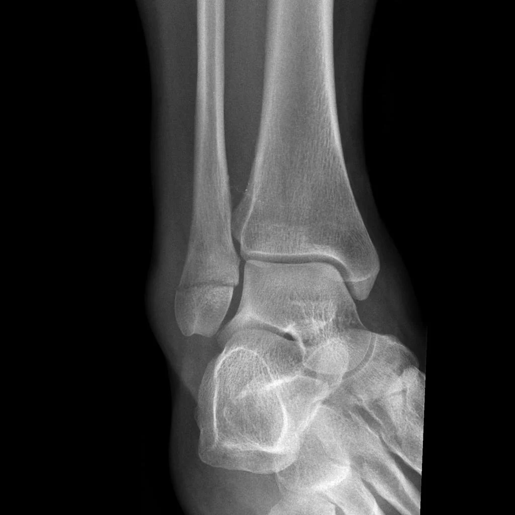 Do you need an XRAY after an Ankle Sprain?
