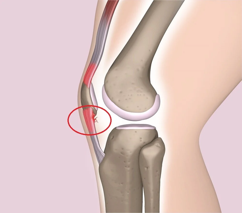 What you need to know about Tendon Injuries (Tendinitis or Tendinopathy)