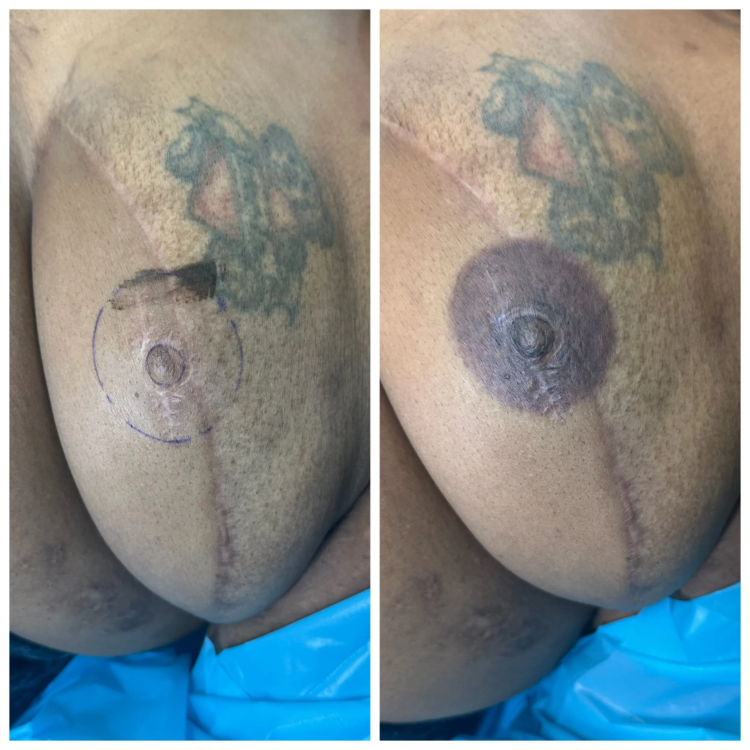 breast reconstruction tattoo