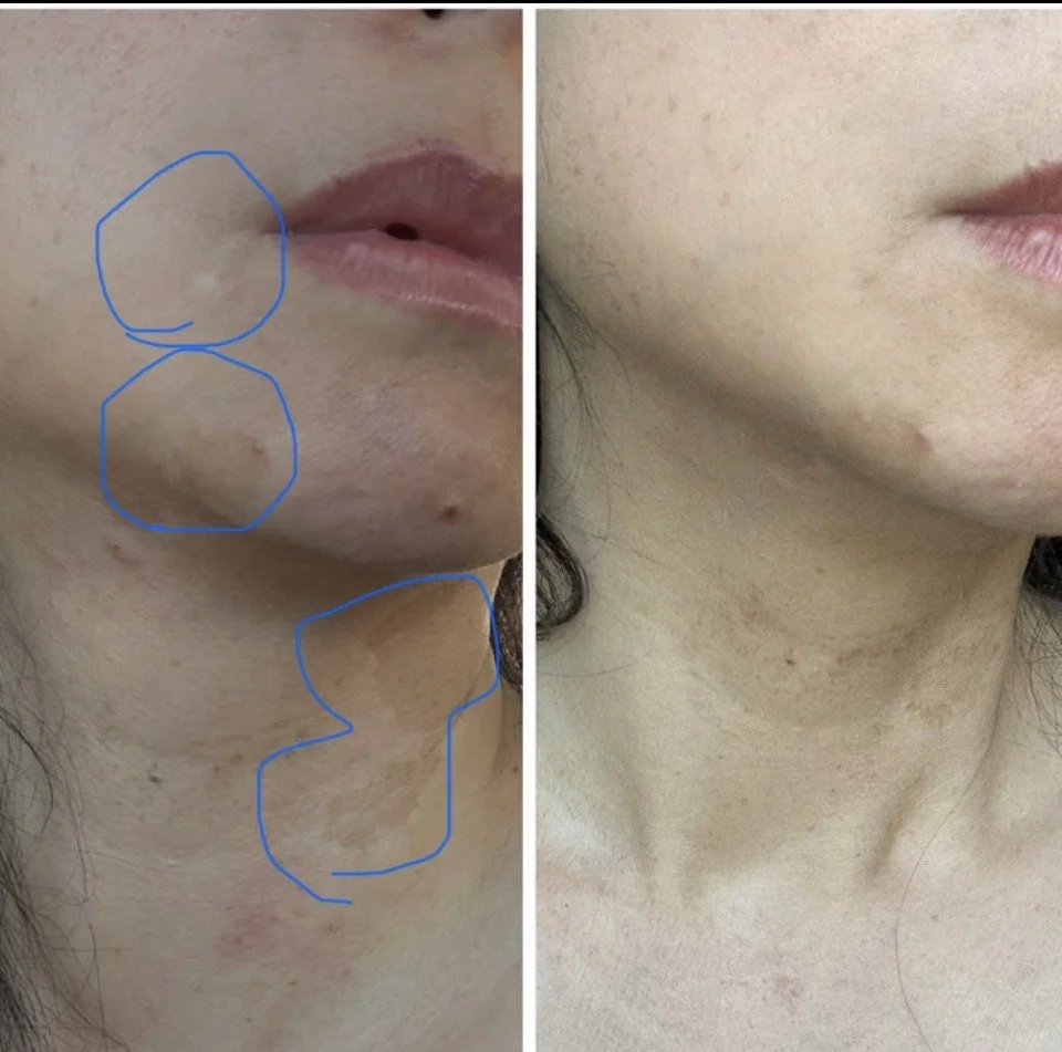 vitiligo cover up permanent