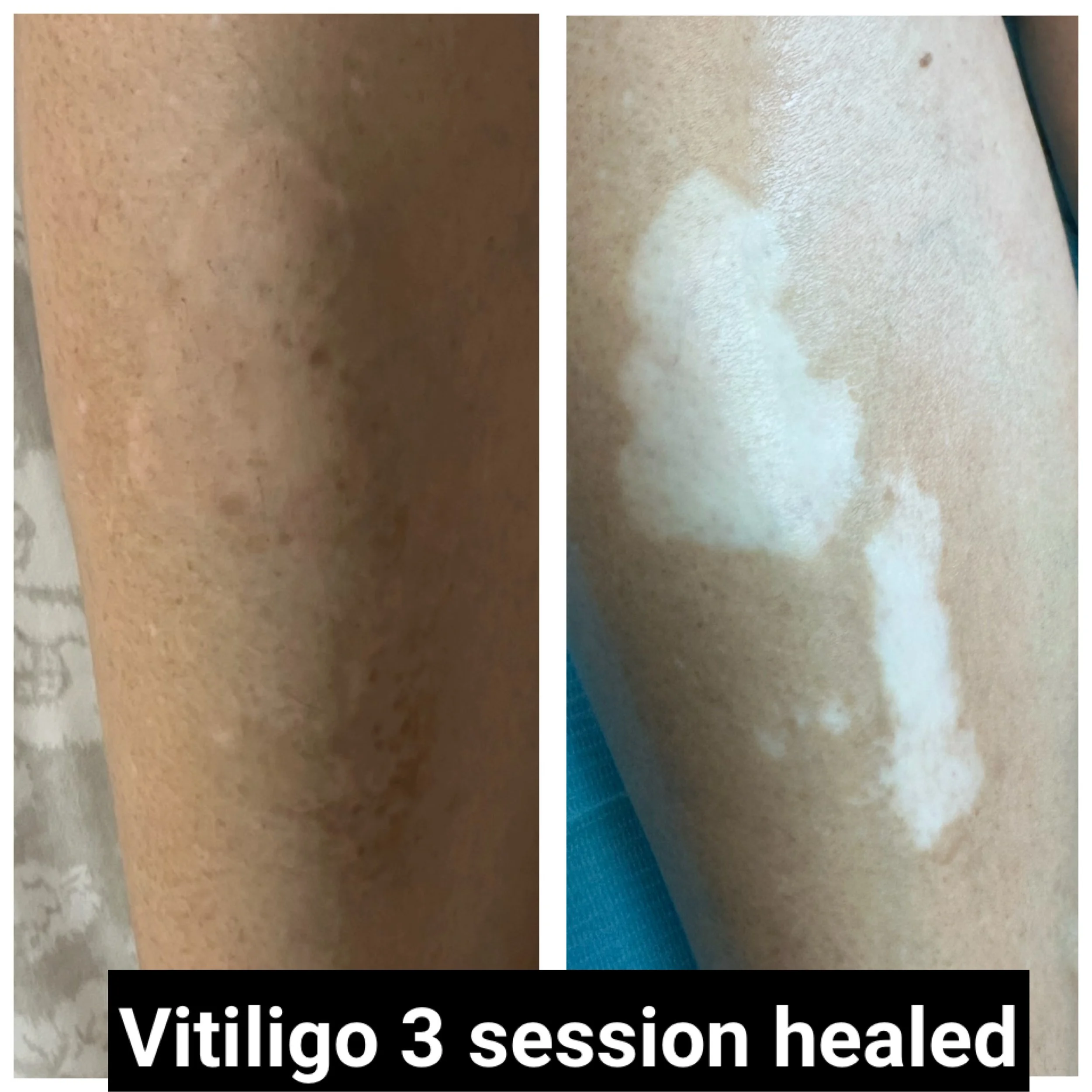 vitiligo treat options