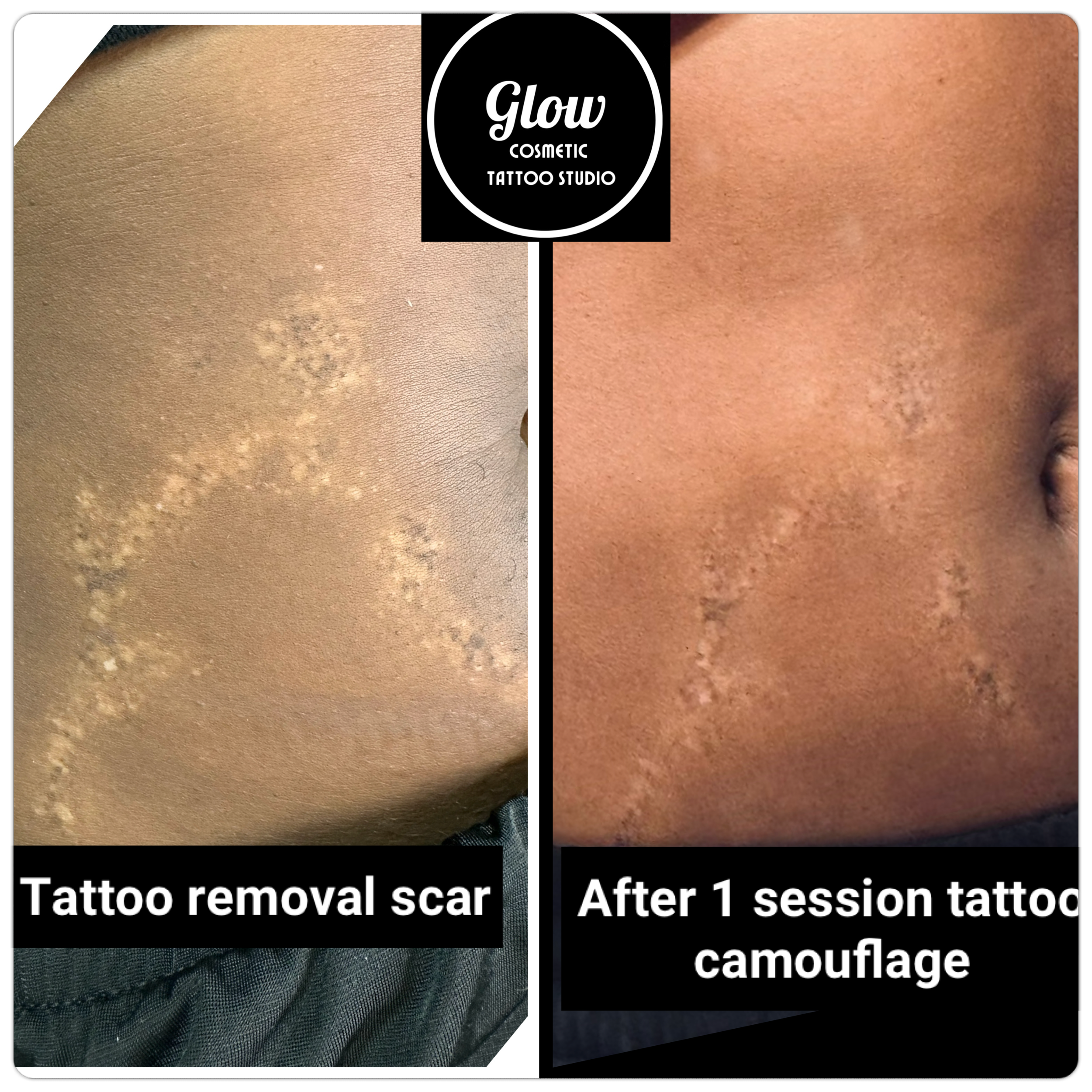 scar from laser hypopigmentation