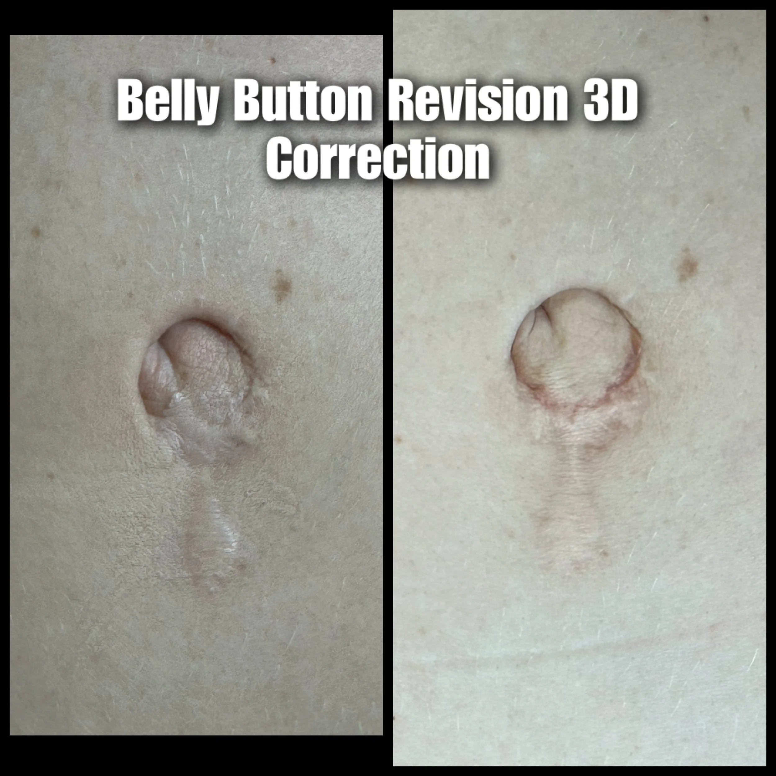 bellybutton scar fix