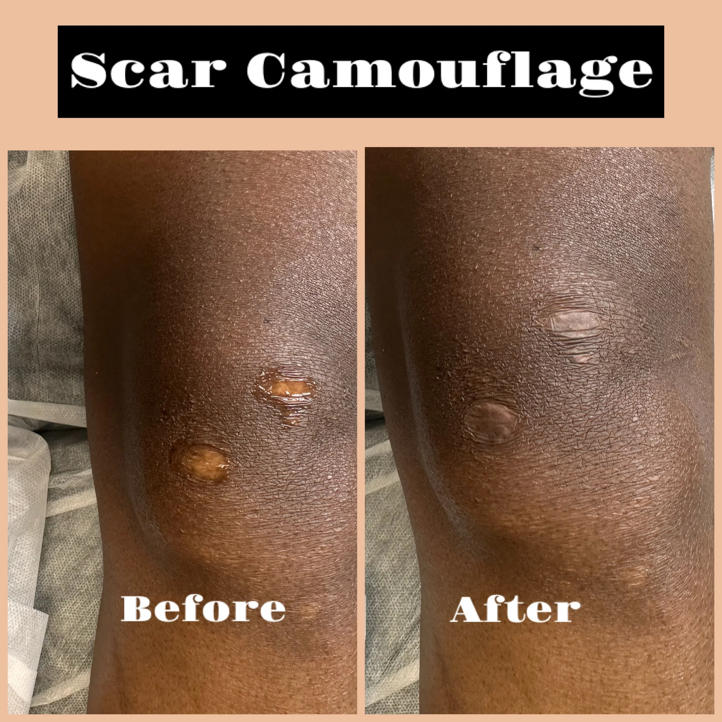 hypopigmentation scarring